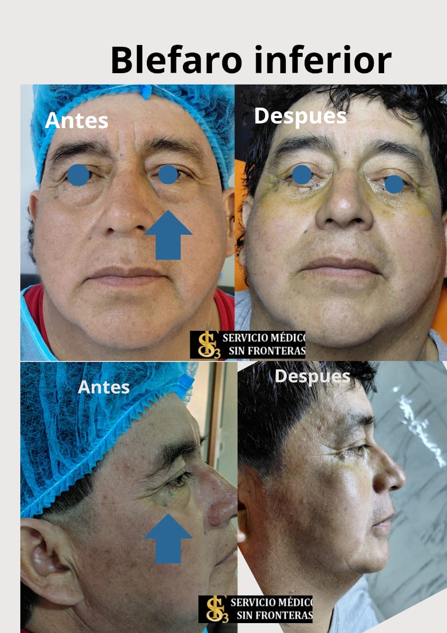 Resultado Blefaroplastia 3